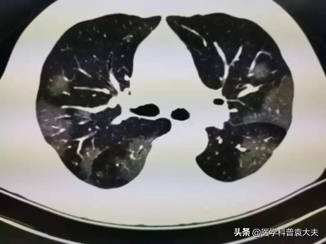新冠肺炎防治第九版，深入理解与实践应用指南