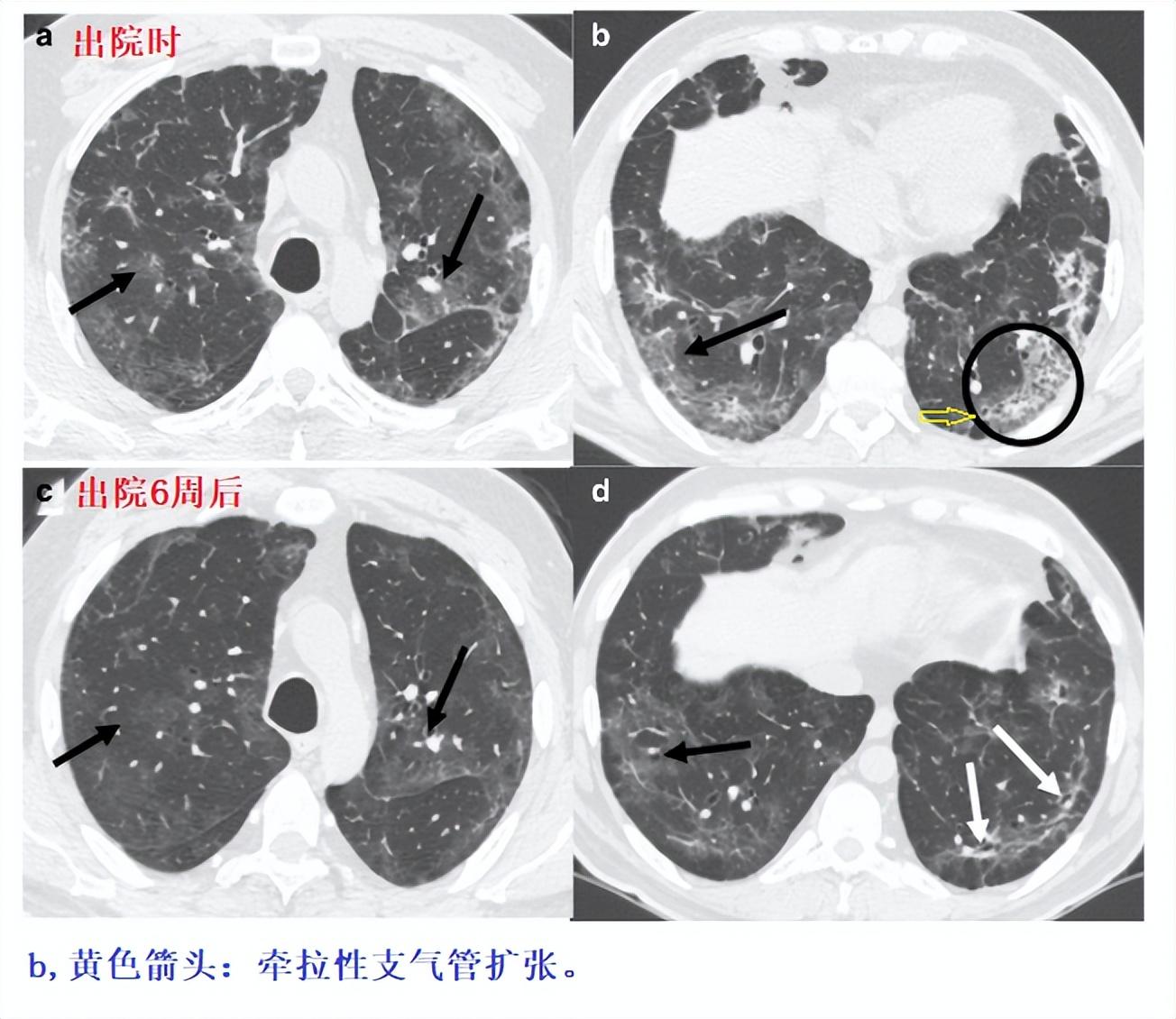 北京机场新冠肺炎管控，全球交通枢纽的防疫攻坚战