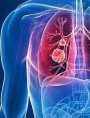 合肥发现一例不明原因肺炎，专家呼吁警惕季节性呼吸道疾病